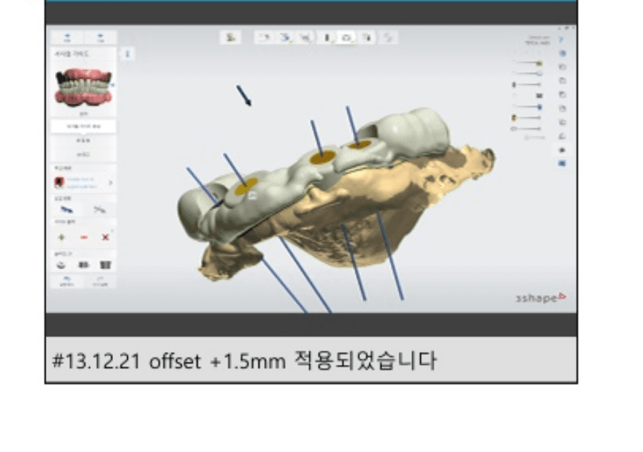 네비게이션 임플란트 치료 과정 3단계 - 개인 맞춤형 가이드 설계