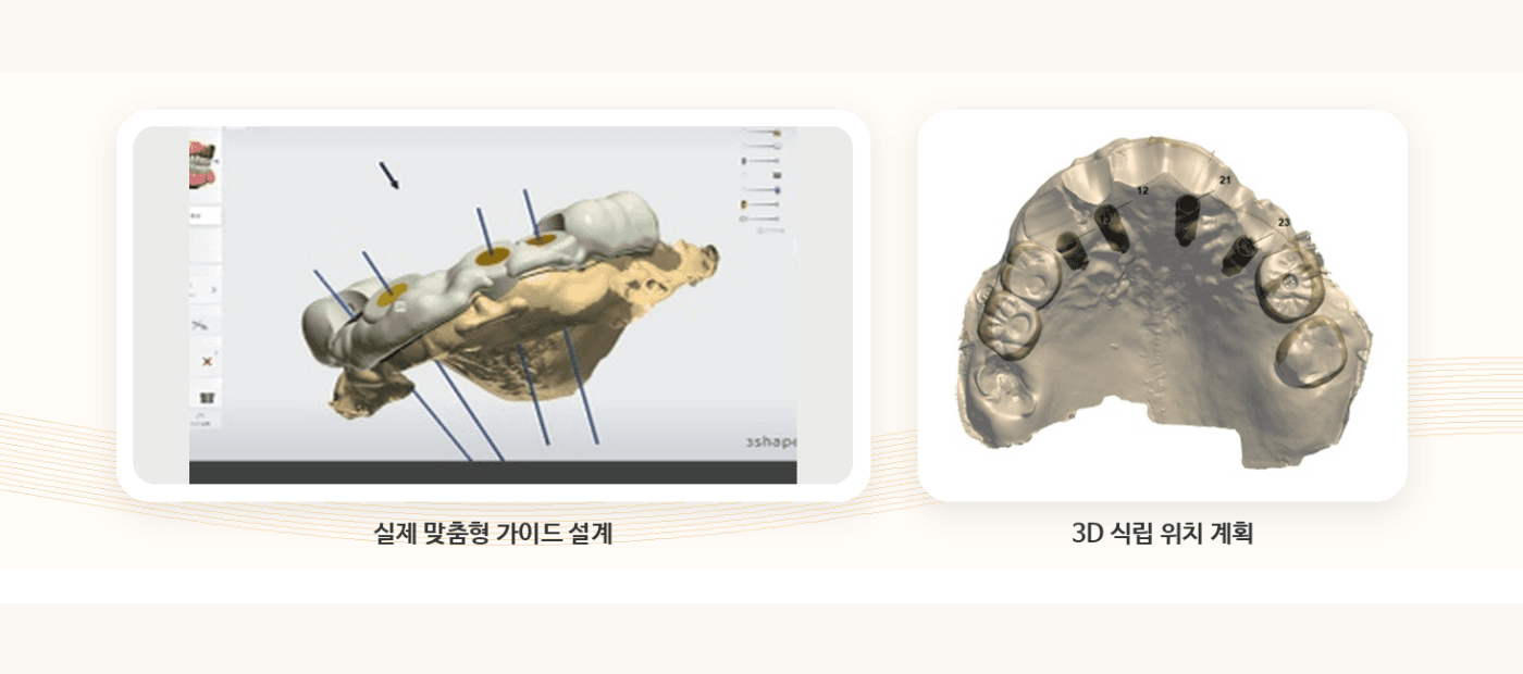 향남 네비게이션 임플란트 진료 안내