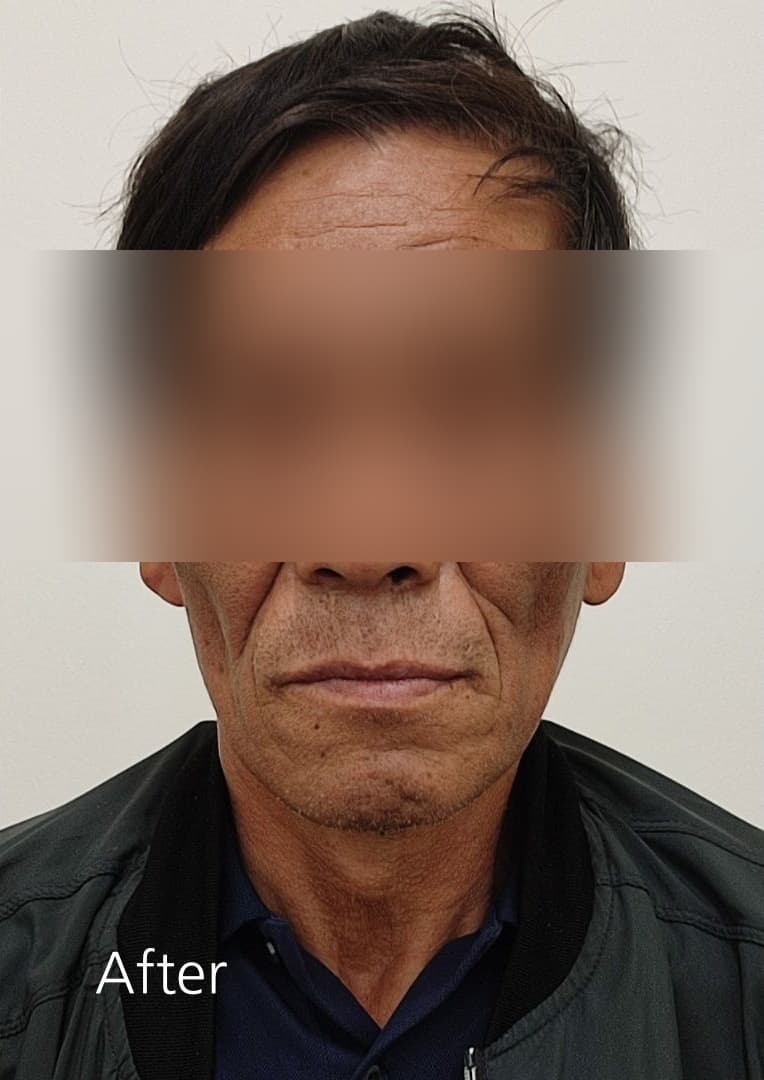 향남 임플란트 뼈이식 임플란트 치료 후 사진