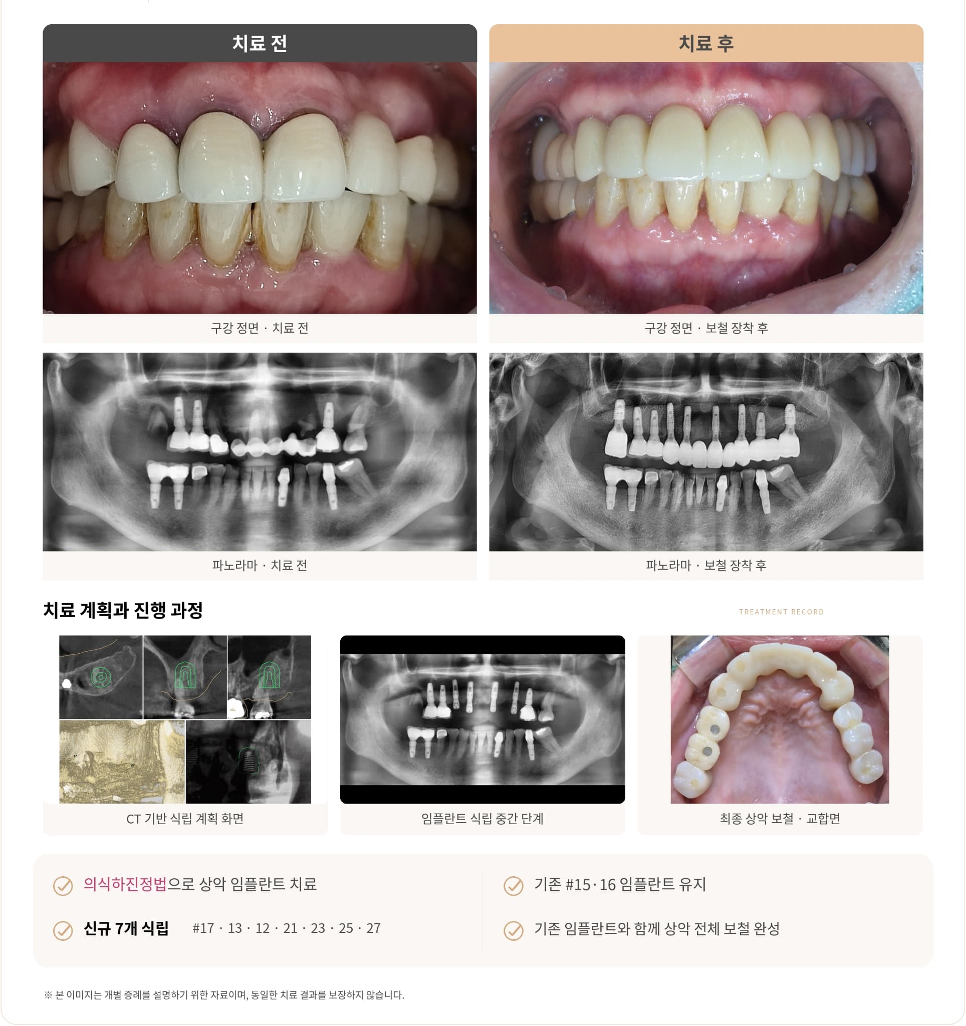 고혈압 병력이 있는 환자의 상악 전체 임플란트 치료 사례 이미지