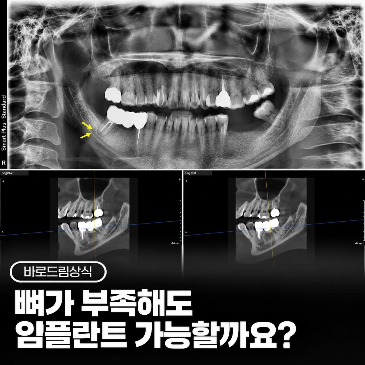 뼈가 부족한 아래 어금니 임플란트를 설명하는 원문 표지 이미지