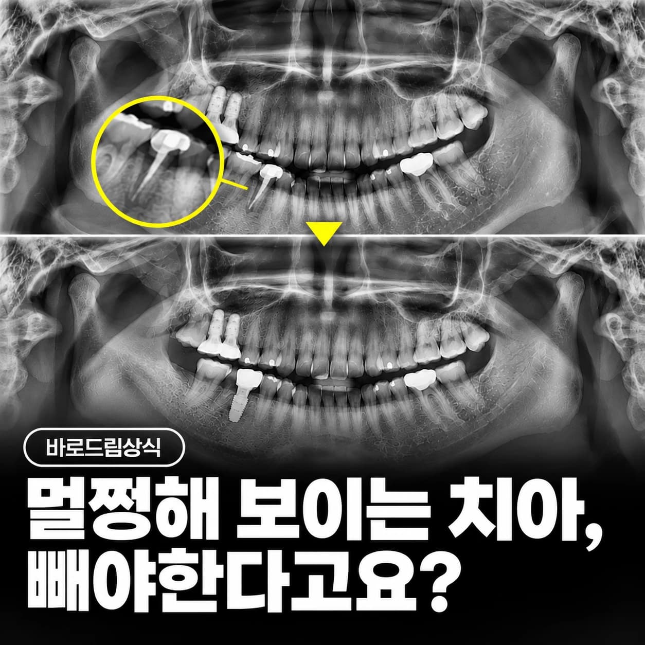 치료 전후 파노라마를 함께 배치한 원문의 치근파절 설명 이미지