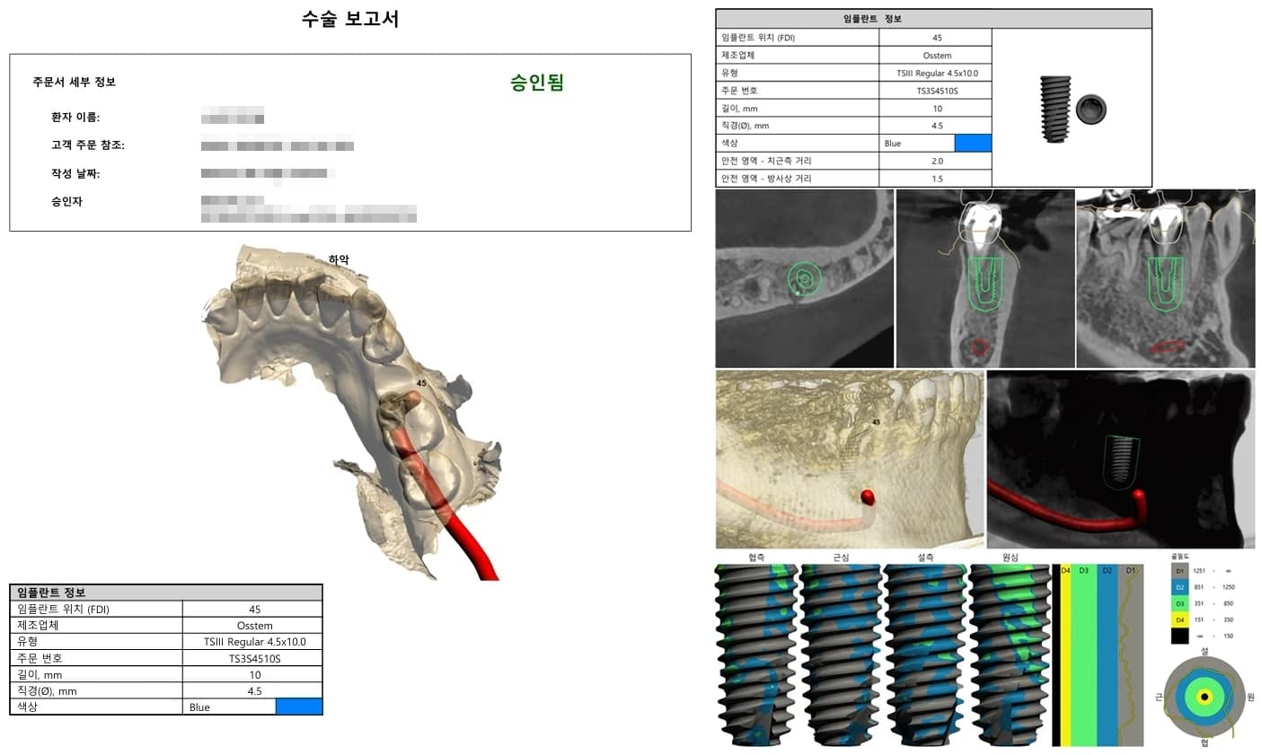 CT와 구강스캔을 바탕으로 임플란트 위치와 방향을 계획한 수술 보고서