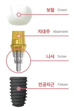 임플란트 본체와 지대주 및 나사와 크라운의 구조