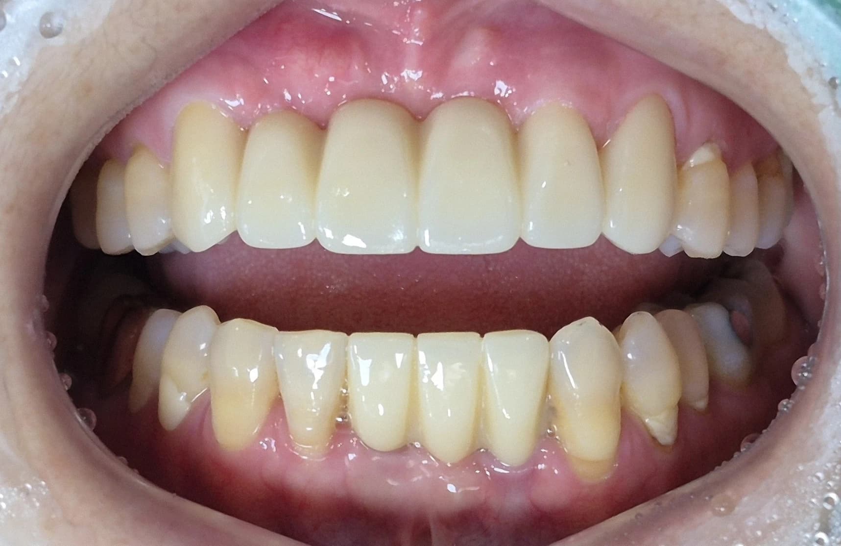 상악 6전치 브릿지를 장착한 뒤 구강사진