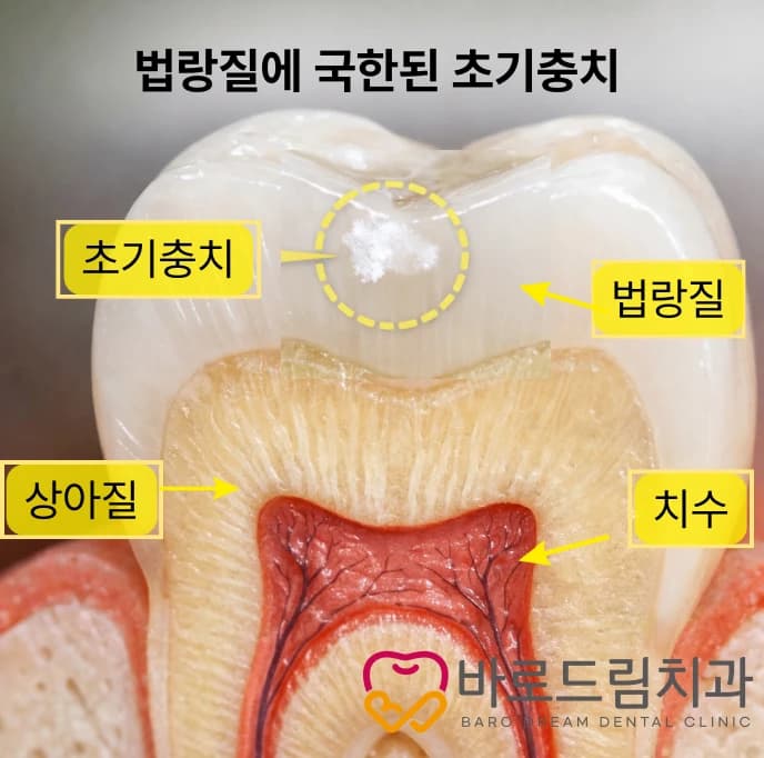 법랑질에 국한된 초기충치와 상아질·치수의 위치를 표시한 원문 설명 그림