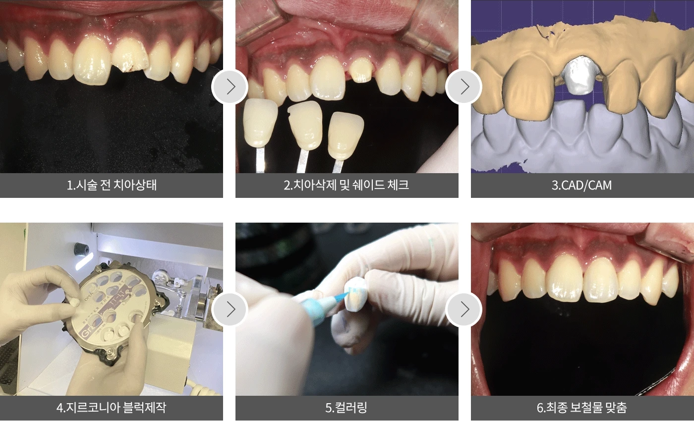 원문에서 제시한 앞니 보철 제작과 장착 과정을 보여주는 단계별 설명 GIF