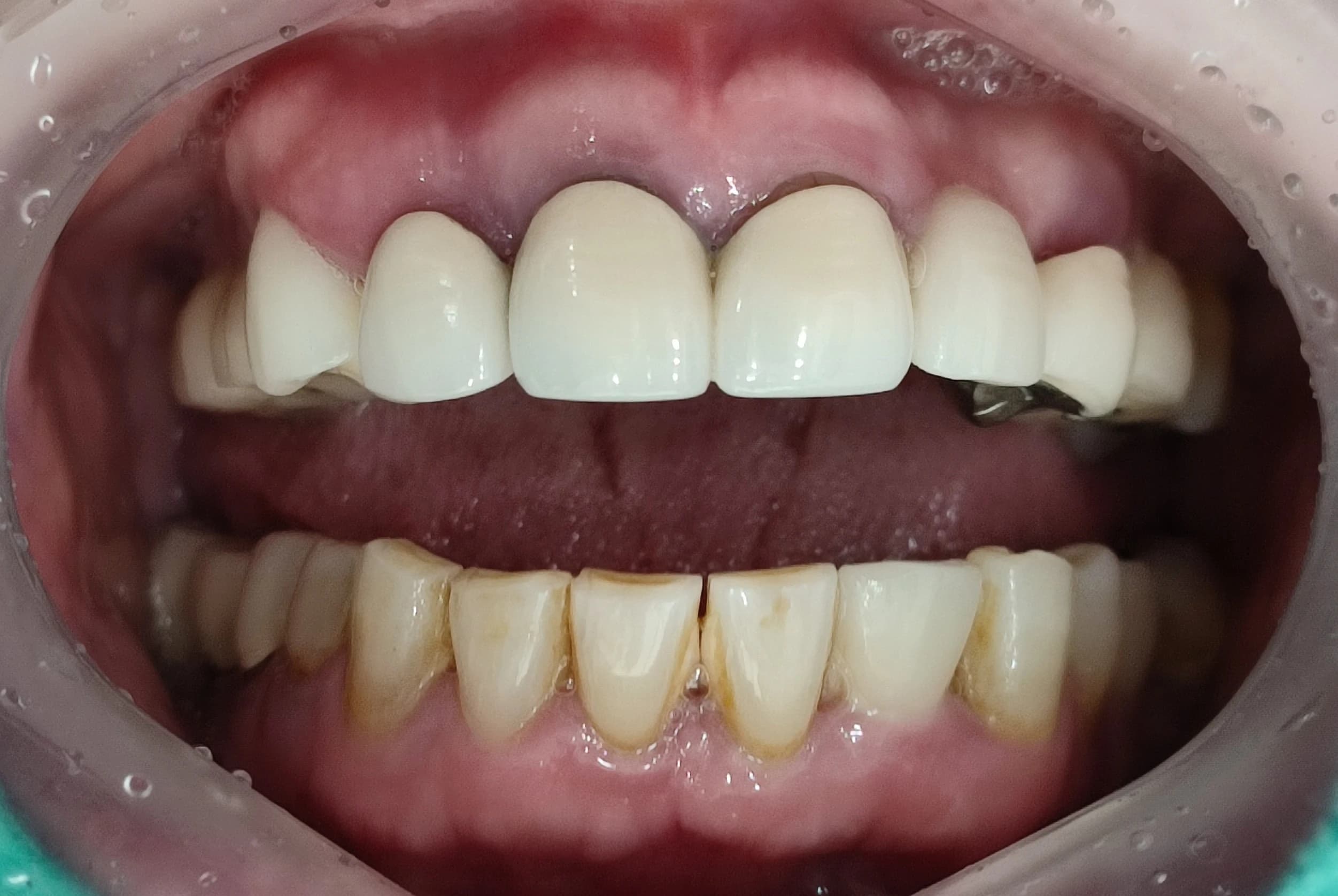 입을 벌린 상태에서 기존 보철과 남은 치아를 보여주는 초진 사진