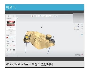 원문에 제시된 수술 가이드 디자인과 오프셋 메모