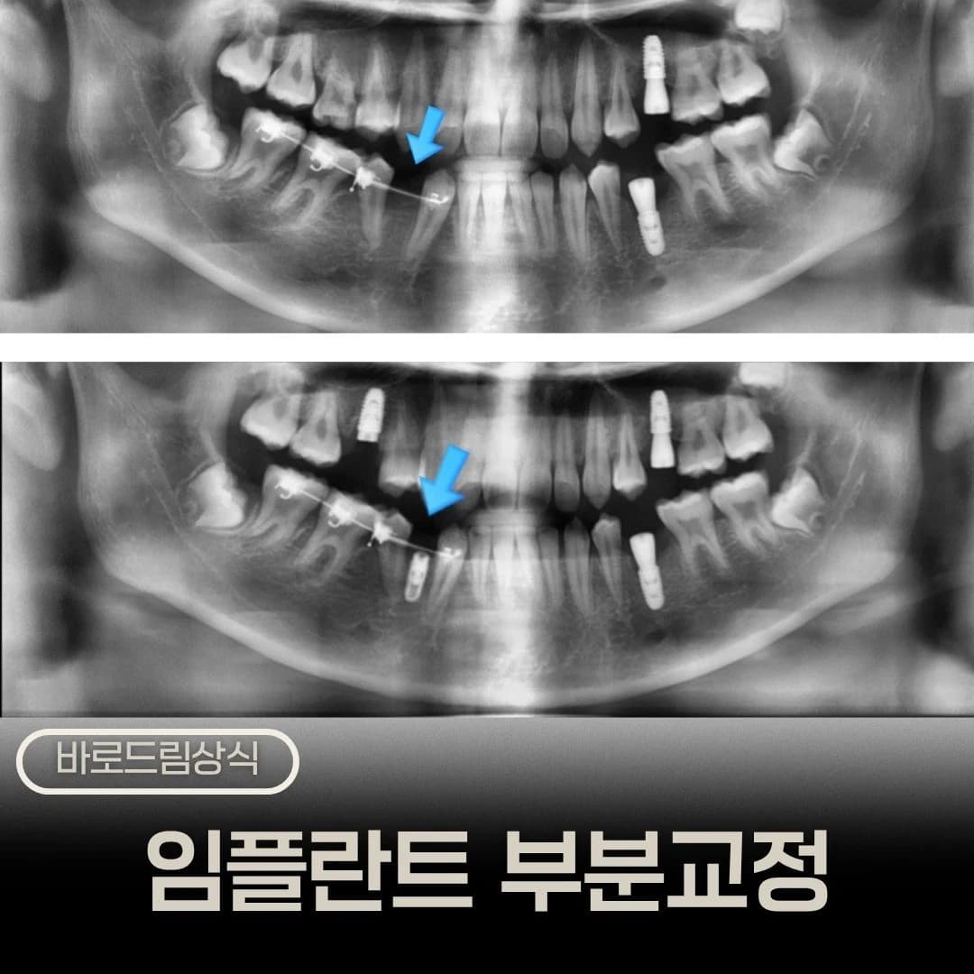 부분교정 전후 임플란트 부위를 비교한 원문 대표 이미지