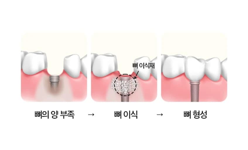 뼈의 양 부족과 뼈이식 및 뼈 형성을 비교한 그림