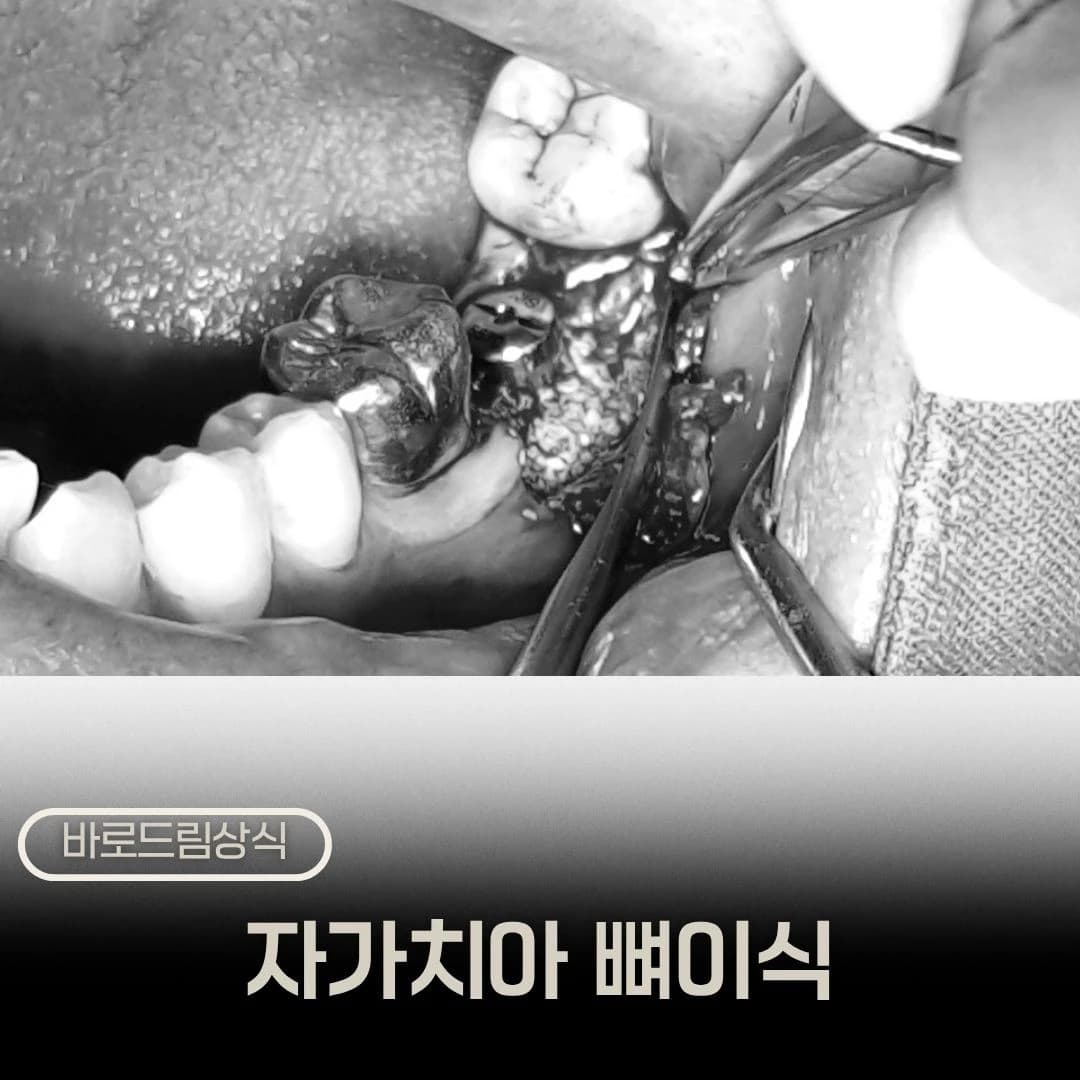 자가치아 뼈이식 재료와 진료 장면을 배치한 원문 표지