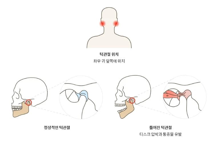 치아 표면의 마모와 힘이 가해지는 부위를 설명하며 제시한 원문 구강사진