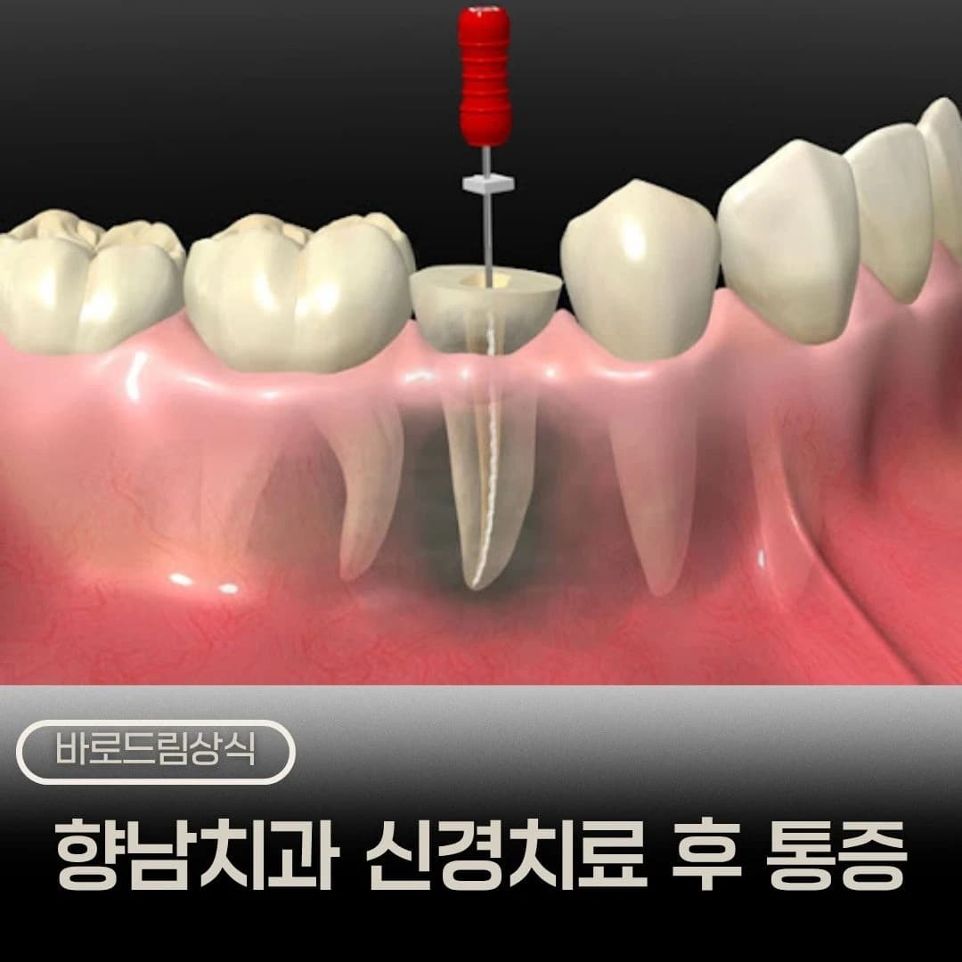 신경치료 후 통증에 관한 질문을 배치한 원문 대표 이미지