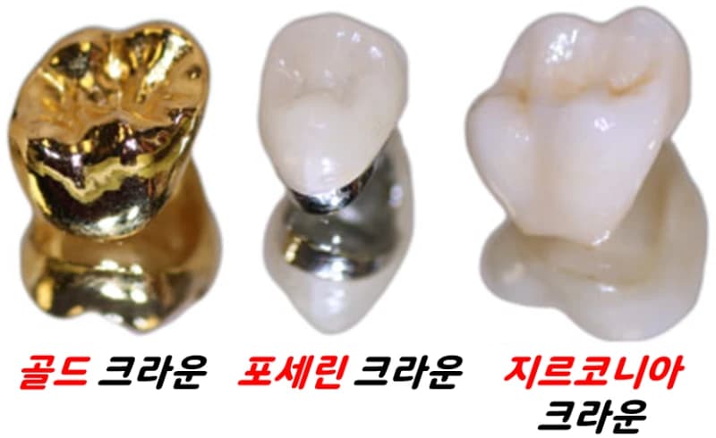 치아를 감싸는 크라운 보철의 형태와 범위를 보여주는 원문 그림