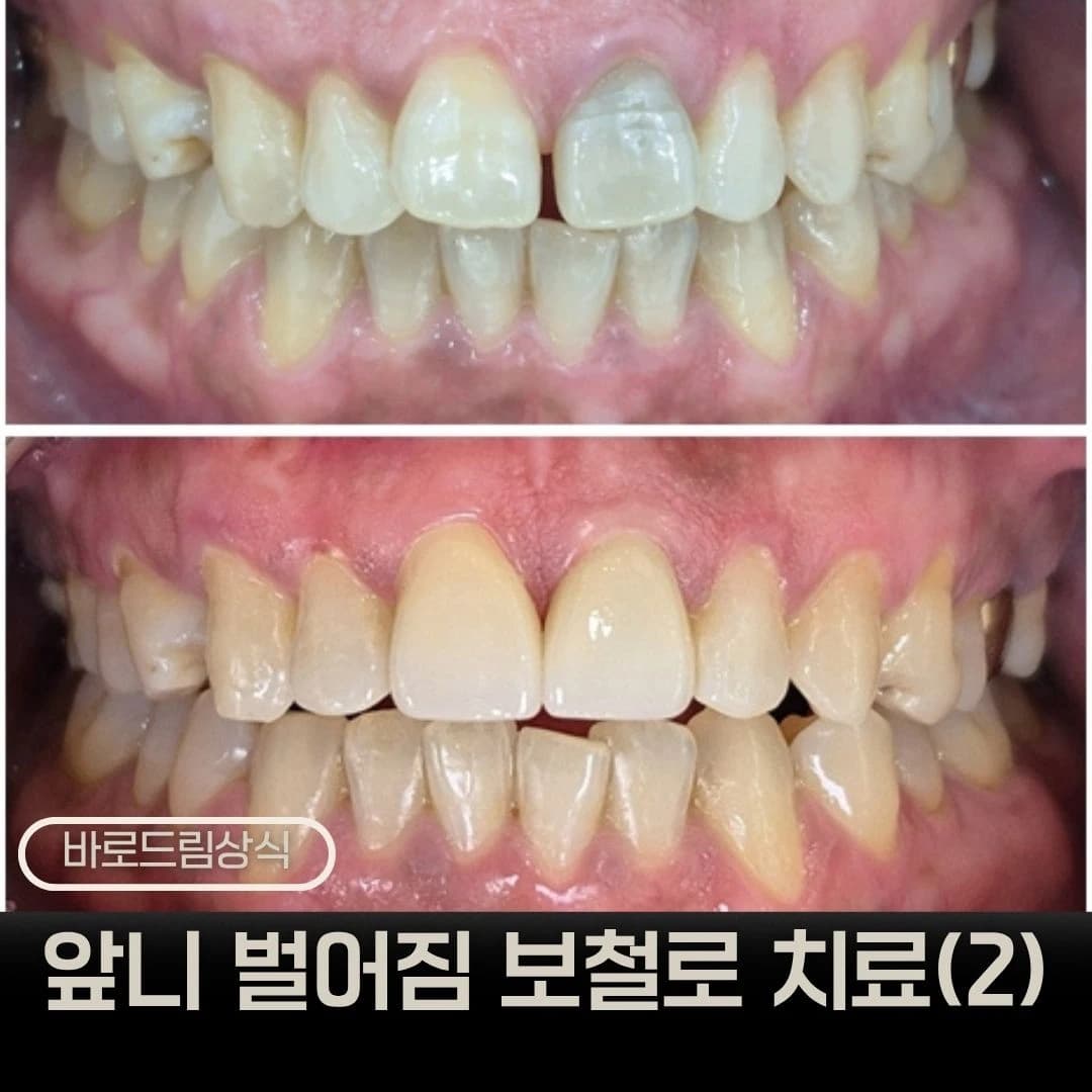 앞니 공간과 치료 전후를 배치한 원문 대표 이미지
