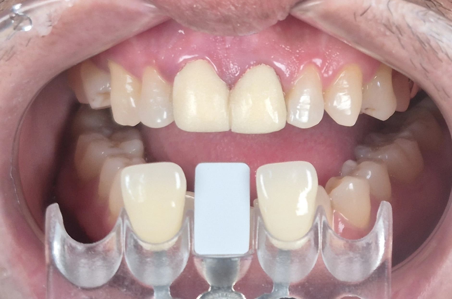 다른 각도에서 앞니 색상을 비교한 쉐이드 확인 사진