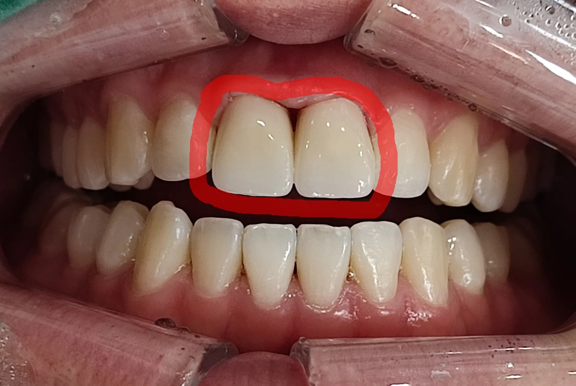 치료한 앞니 부위를 빨간 선으로 표시한 구강사진