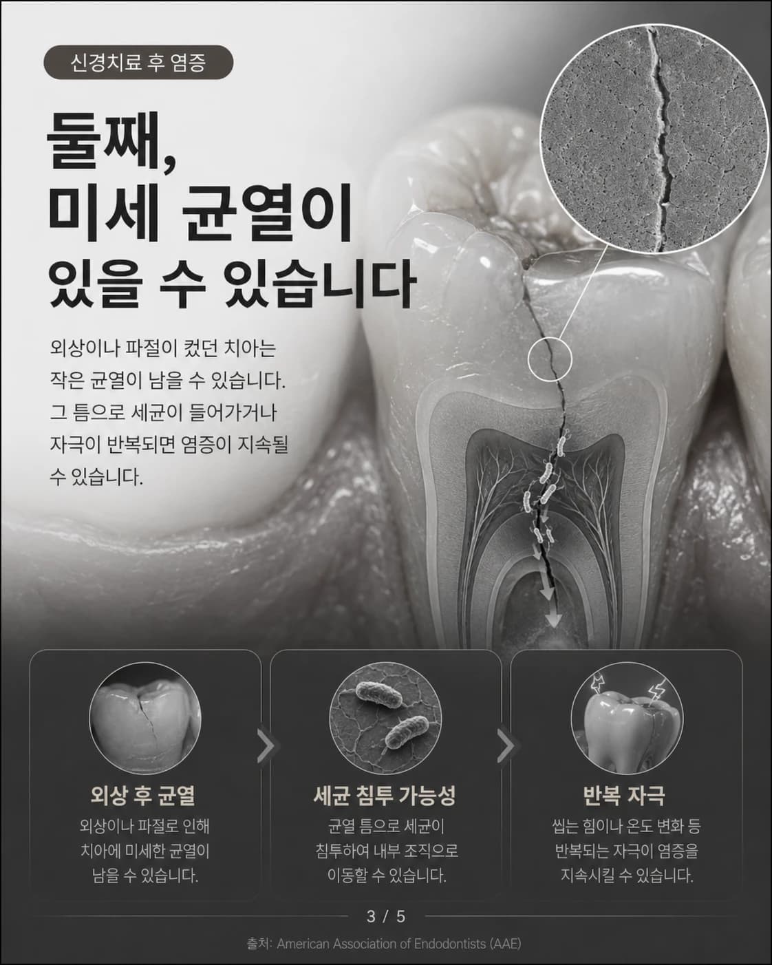 치아의 미세 균열 가능성을 설명한 원문 교육 이미지