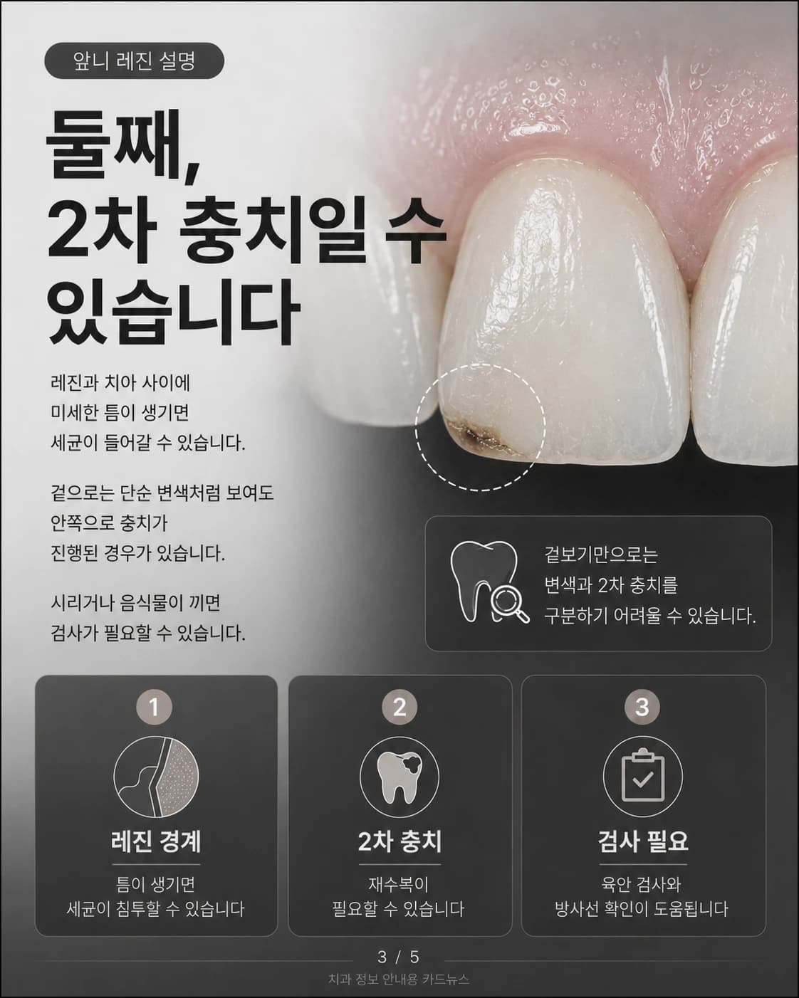 레진 경계의 이차 충치를 설명한 원문 교육 이미지