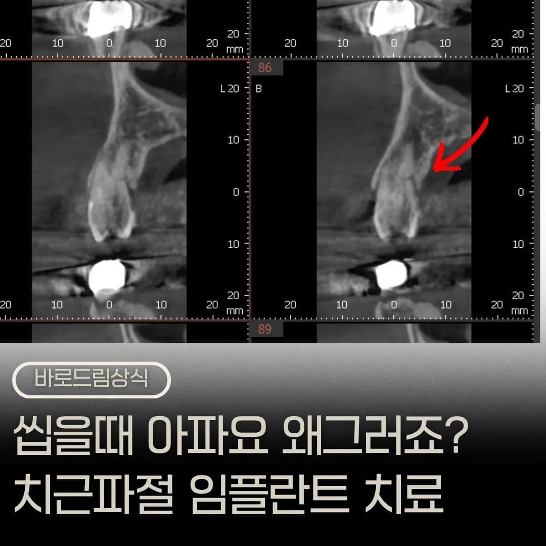 파절 치아와 구강사진을 배치한 원문의 치근파절 대표 이미지