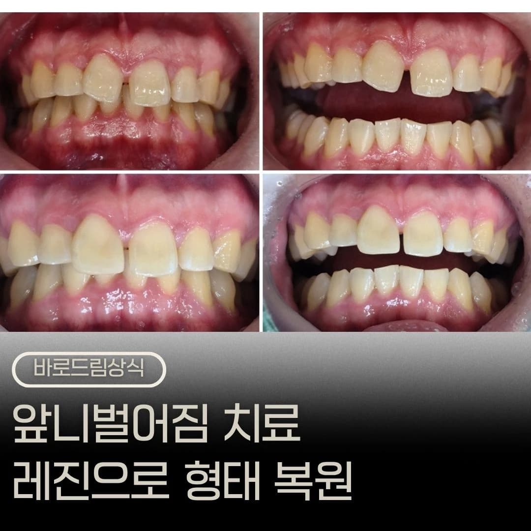 앞니 레진 치료 전후 구강사진을 배치한 원문 대표 이미지