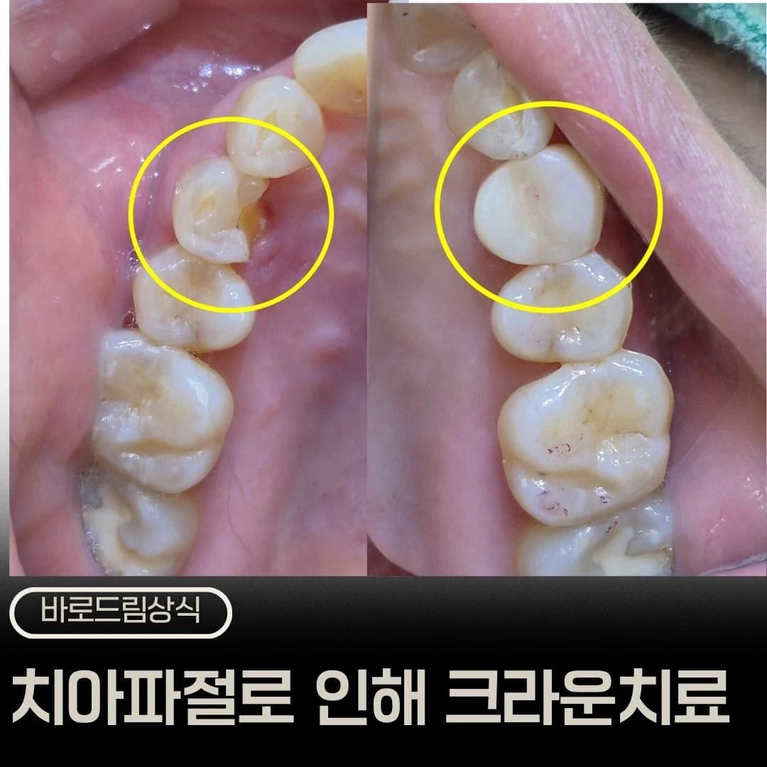 치관 파절과 크라운 치료를 소개한 원문 대표 이미지