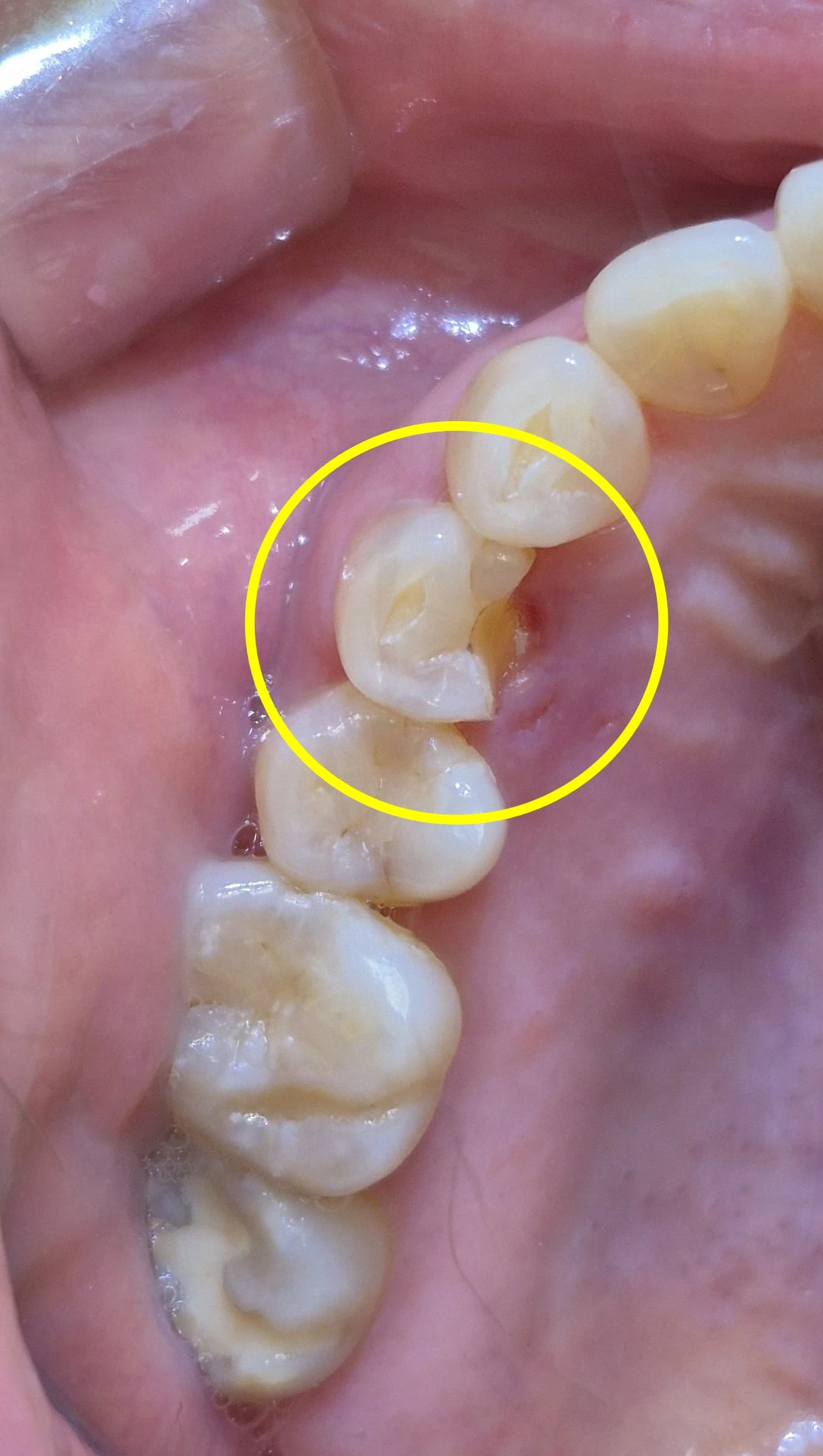첫 번째 사례의 파절된 24번 치아를 보여주는 치료 전 구강사진