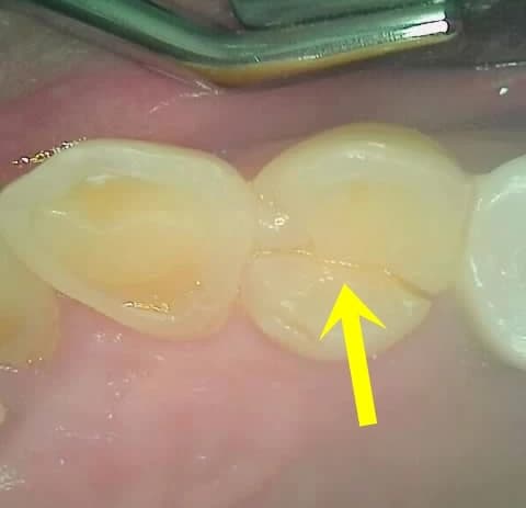 세 번째 사례의 파절 치아 방사선 자료