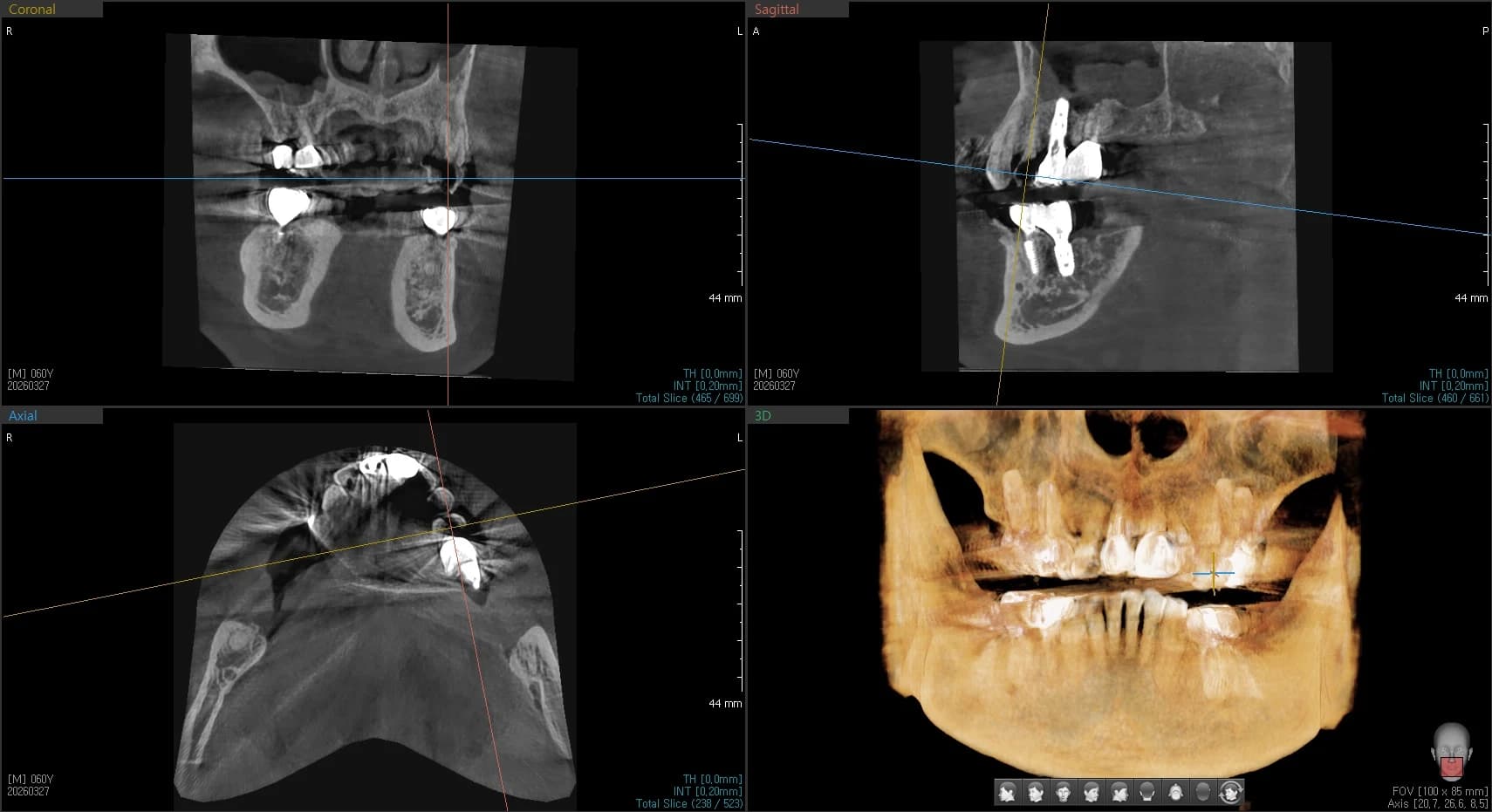 세 번째 사례의 치근 파절 확인에 제시된 CBCT 자료 2