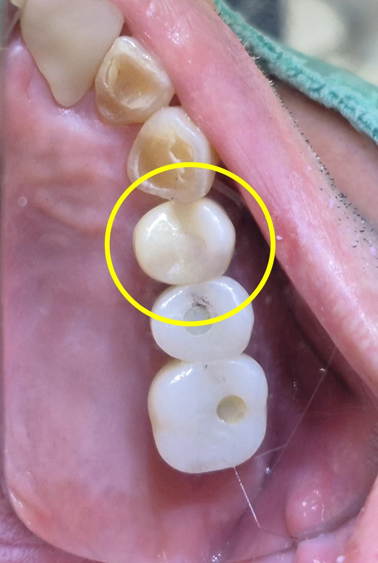 세 번째 사례의 임플란트 보철 치료 후 구강사진 1