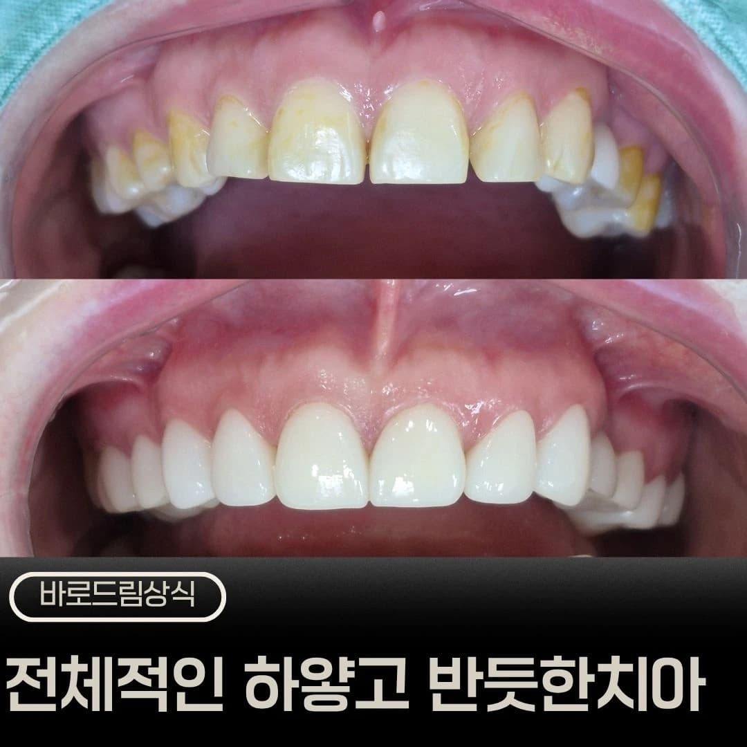 전체 크라운 치료 전후 앞니 모습을 배치한 원문 표지