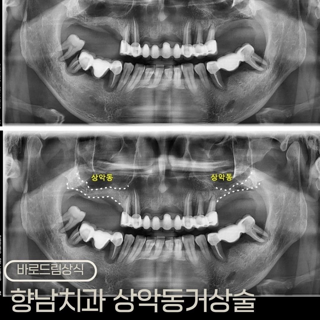 상악동 위치를 표시한 파노라마를 배치한 원문 대표 이미지
