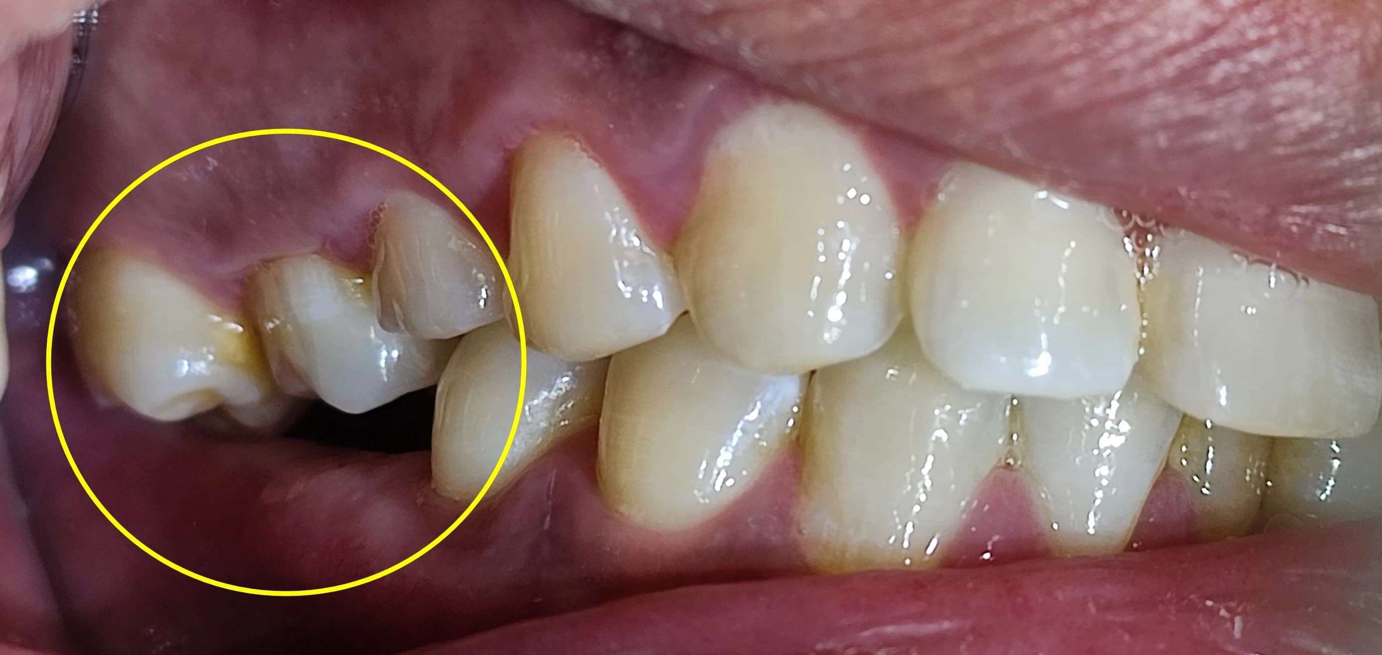 정출된 위쪽 어금니를 노란 원으로 표시한 초진 구강사진