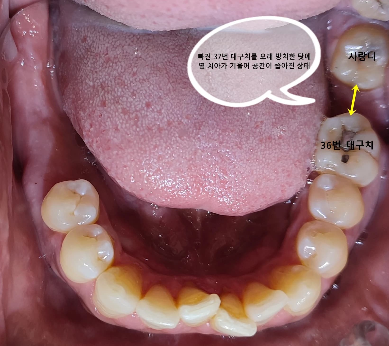 37번 결손 부위의 좁아진 공간을 설명한 아래 치열 사진