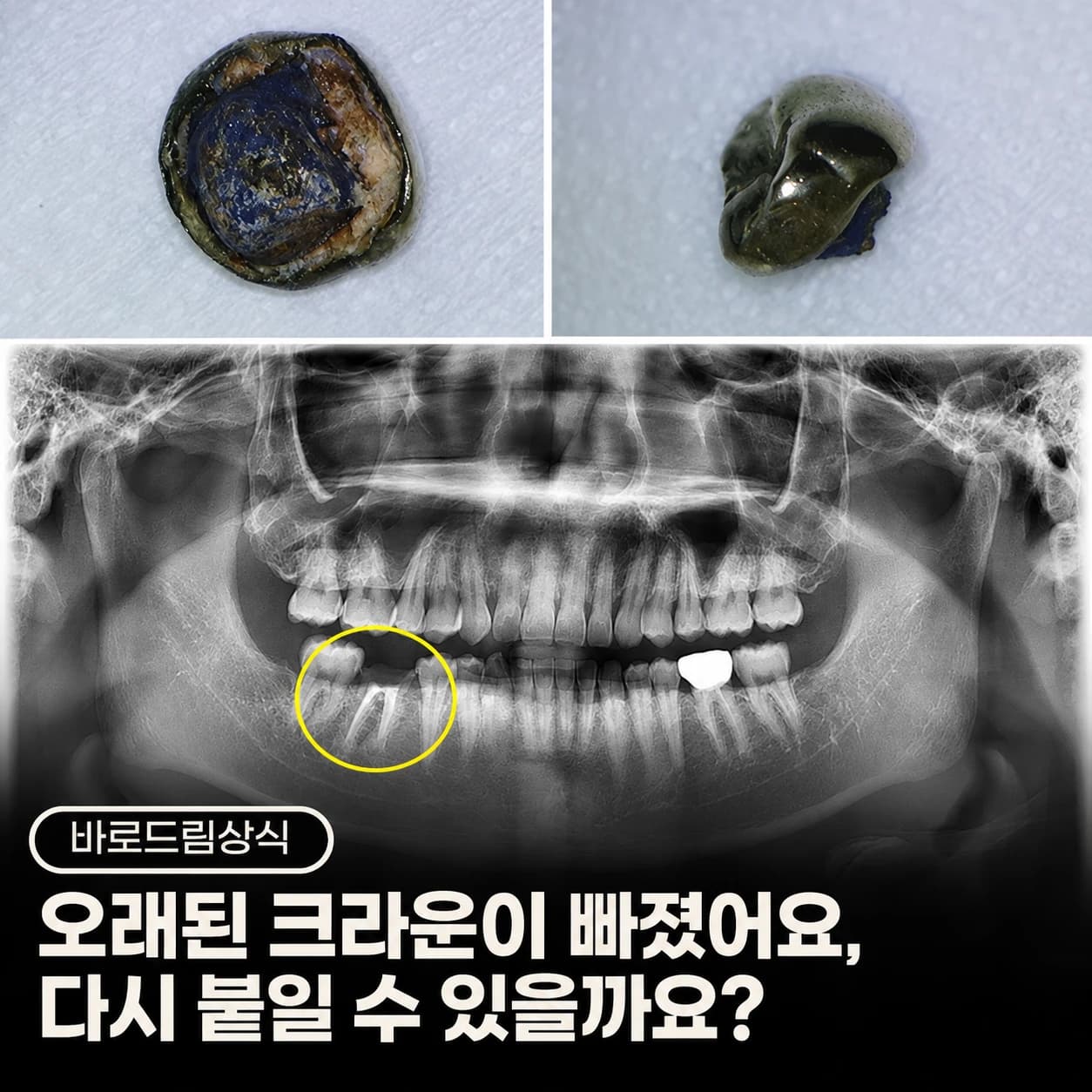 탈락한 크라운과 파노라마를 함께 배치한 원문 표지