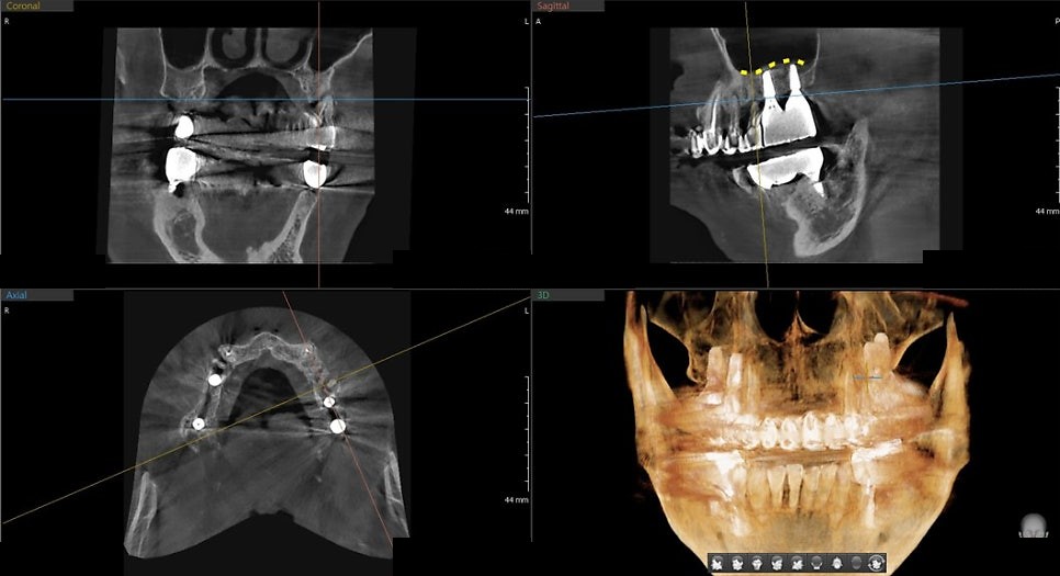 향남치과 향남상악동거상술 수술 후 CT